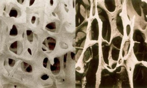 Osteoporosis, cambios en la arquitectura ósea.