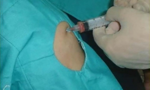 Medicina regenerativa en Cuba, implante de Células madre en rodilla