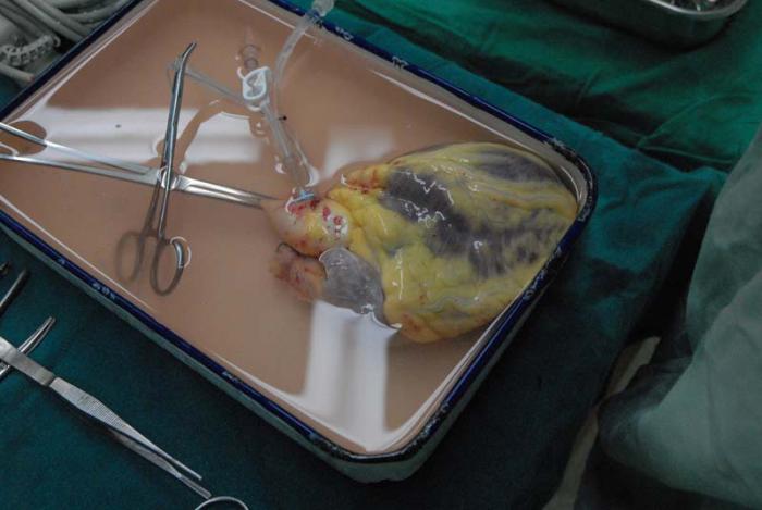 Corazón listo esperando explante del corazón enfermo 