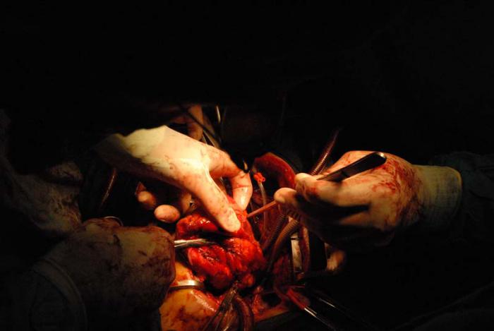 Excérecis del corazón enfermo 