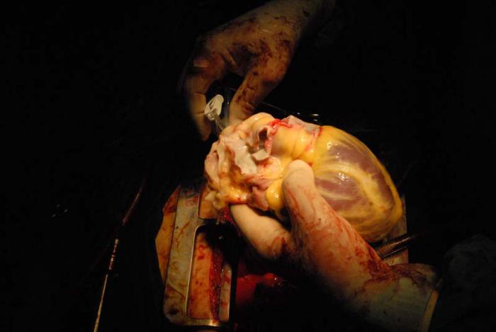 Instantes previos al implante del corazón