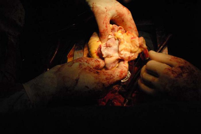 Momento en que se realiza el implante del corazón