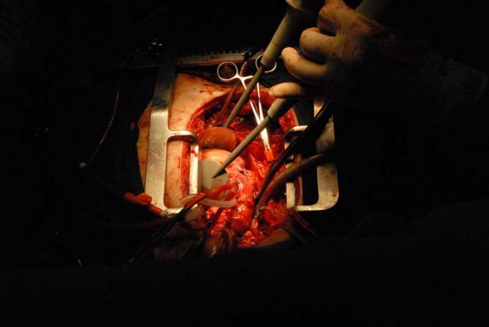 El corazón fibrila cuando se retira el punzamiento aórtico y se le da un primer choque