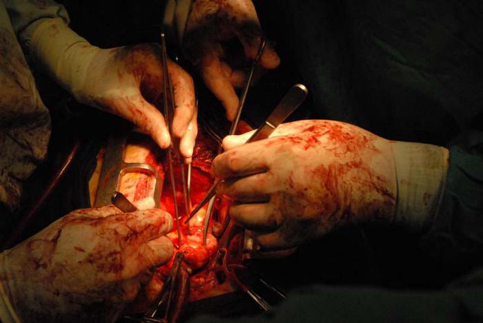 Listo el paciente para recibir el nuevo corazón 