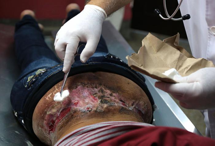 Cura de lesiones residuales de angiodisplasia de alto flujo de la región lumbosacra