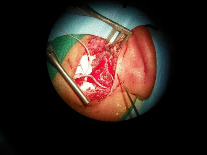 Cirugía de implante coclear