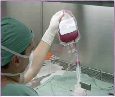 Bolsa con obtención de células madre de sangre periférica.