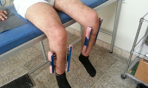 Alargamiento de extremidades