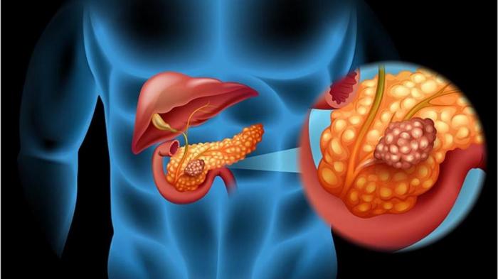 Cáncer de páncreas. Imagen ilustrativa. Foto tomada de EFE Salud.