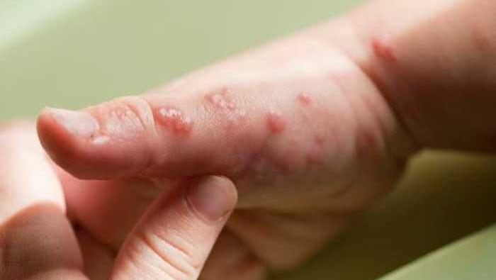 La mayor parte de los pacientes infectados por la viruela del mono muestran un cuadro clínico con evolución favorable, pero puede llegar a ser grave en niños, mujeres embarazadas y personas inmunodeprimidas.
