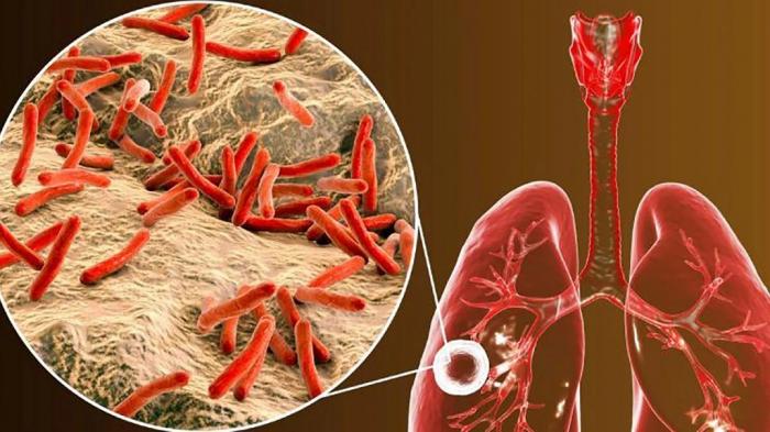 tuberculosis