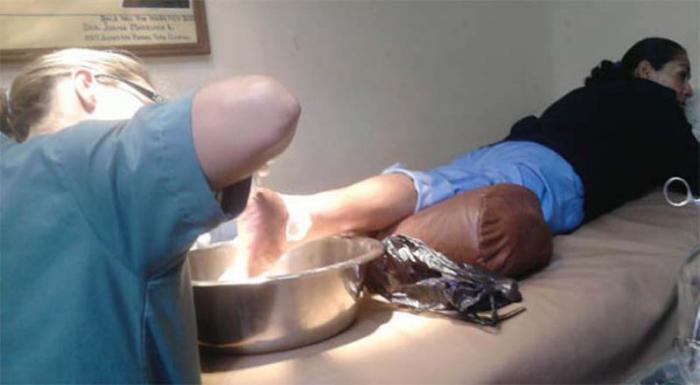 Piede diabetico che riceve il trattamento con il Heberprot-P.